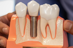 dental implant  is a post to replace a missing tooth root