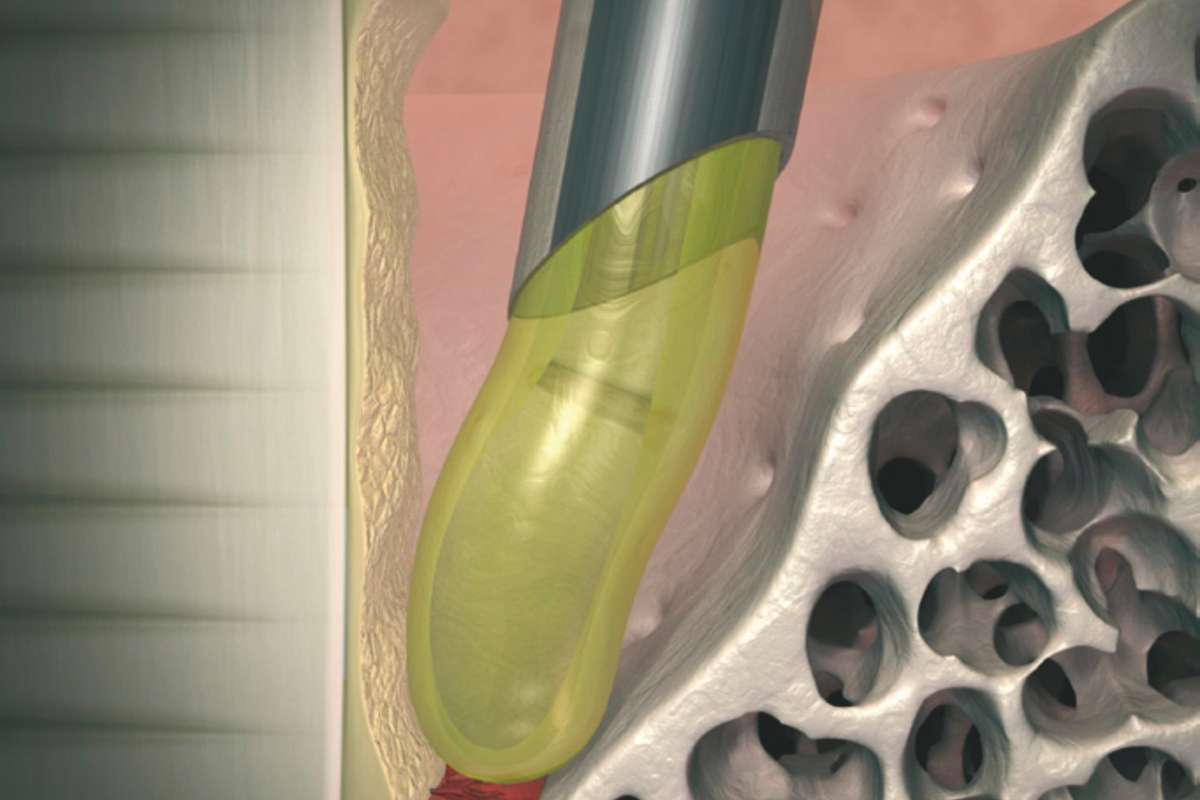 Illustration of a dental implant in a jawbone. The image shows a cross-section with the implant inserted, surrounded by bone tissue. The implant is depicted in metallic gray and yellow colors, highlighting the integration with the bone structure.